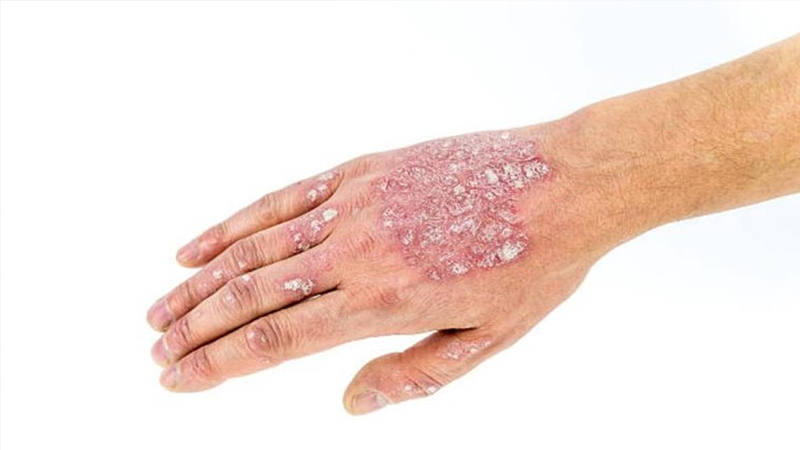 Mengenal Penyakit Psoriasis dan Cara Mencegahnya – PAFI Kab. Indragiri Hulu